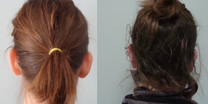Otoplasty, after  7 days